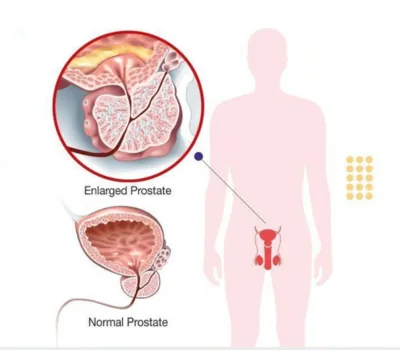 Illustration comparing a normal prostate with an enlarged prostate